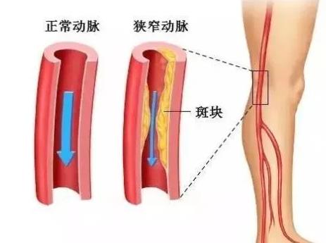 無創(chuàng)動脈硬化檢測你做過嗎？